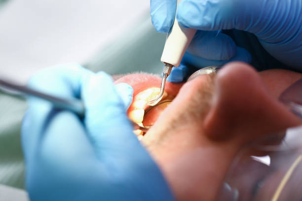 Best Emergency Treatment for Dental Infections or Abscesses in Fort Loramie, OH
